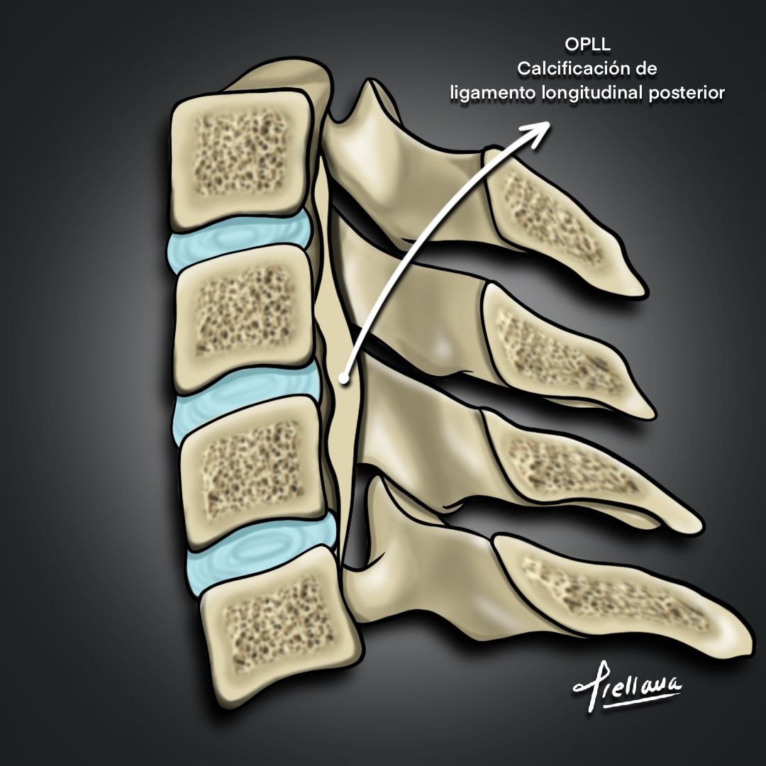 Dr. Marcelo Orellana · Que es la calcificación del ligamento