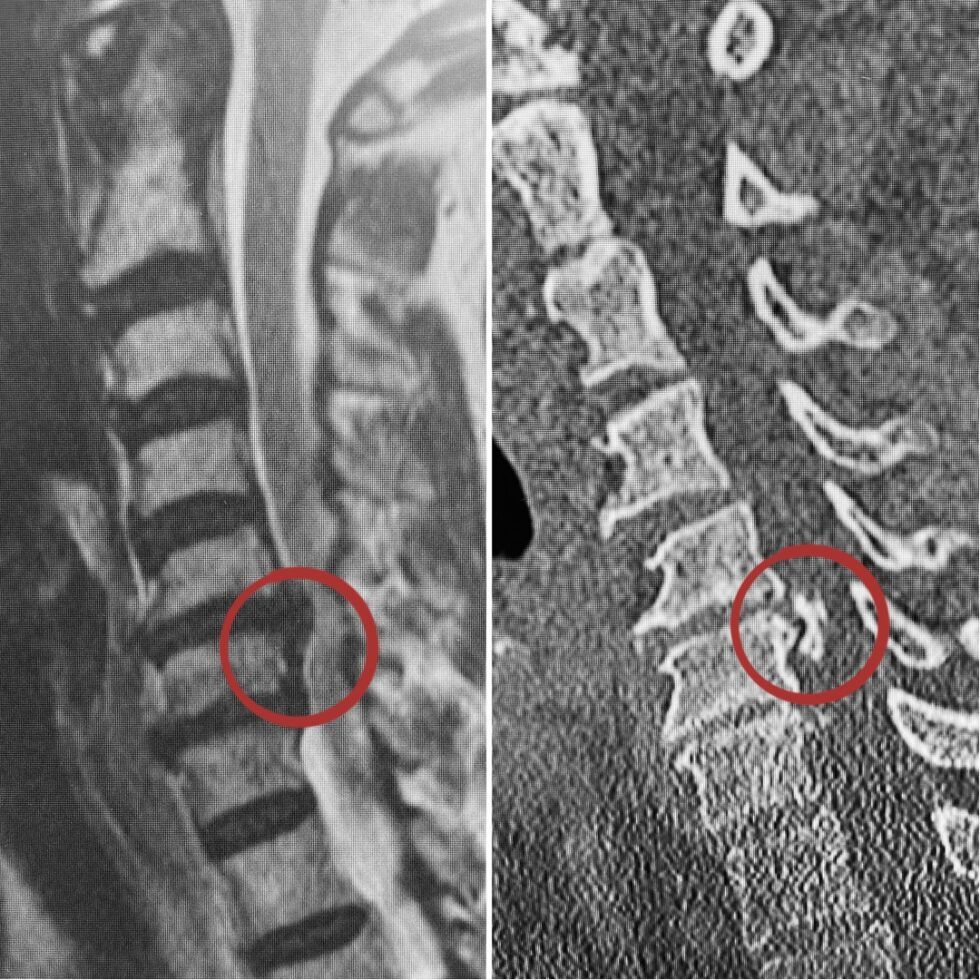 Dr. Marcelo Orellana · Que es la calcificación del ligamento
